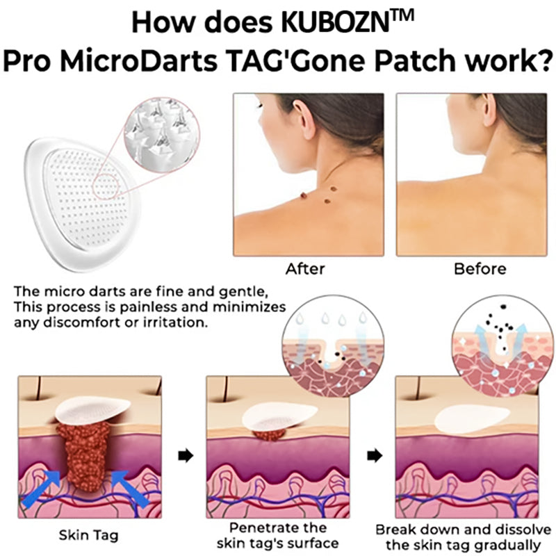 KUBOZN™ Pro MicroDarts TAG'Gone Patch