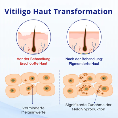 Cvreoz® Spray zur Behandlung von Vitiligo (offer)