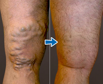 Cvreoz® VenoAid Varizen-Lösungsspray