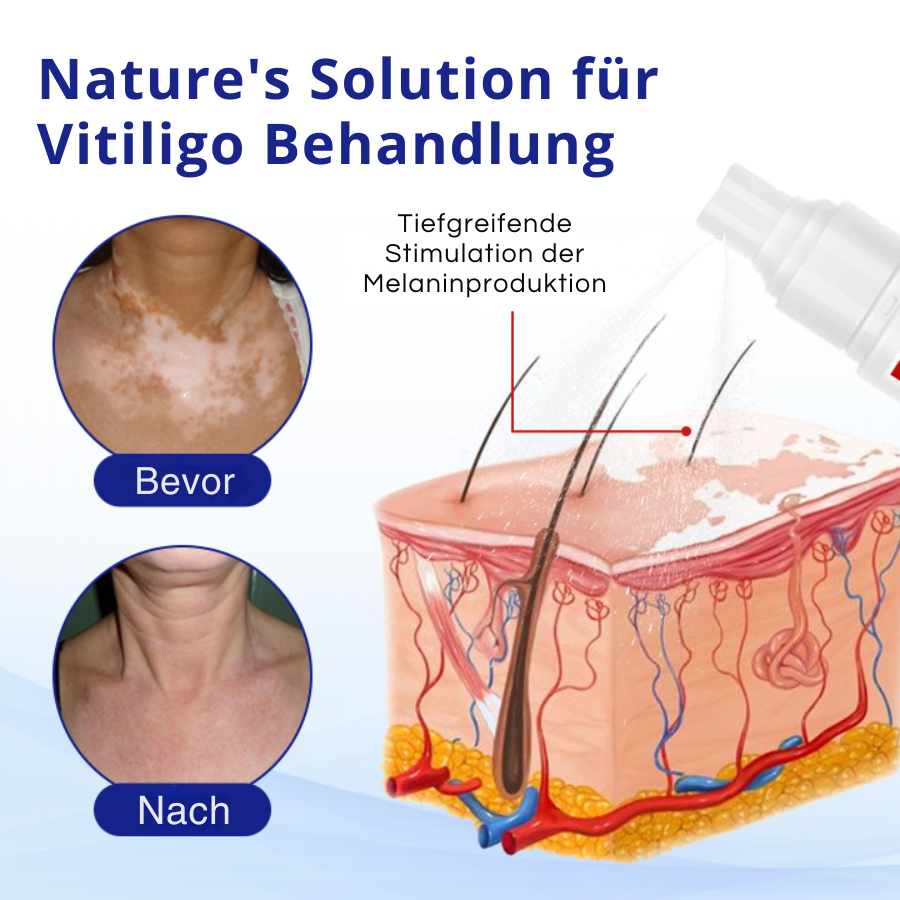 Cvreoz® Spray zur Behandlung von Vitiligo (offer)