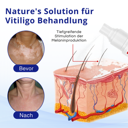 Cvreoz® Spray zur Behandlung von Vitiligo (offer)