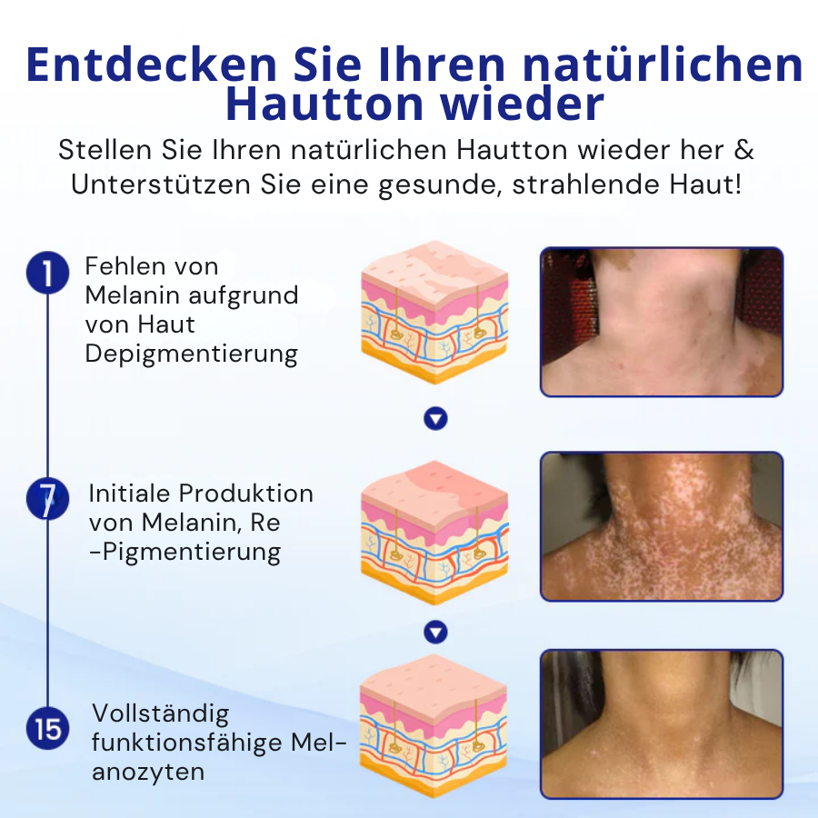 Cvreoz® Spray zur Behandlung von Vitiligo (offer)