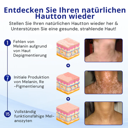 Cvreoz® Spray zur Behandlung von Vitiligo (offer)